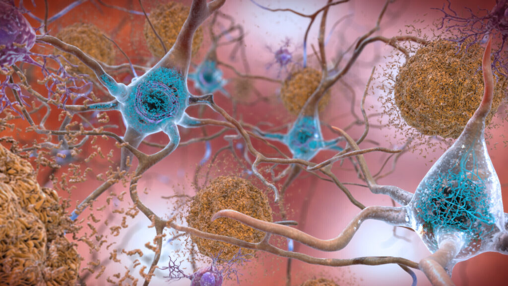 U.K. says Alzheimer’s drugs Kisunla, Leqembi aren’t cost-effective