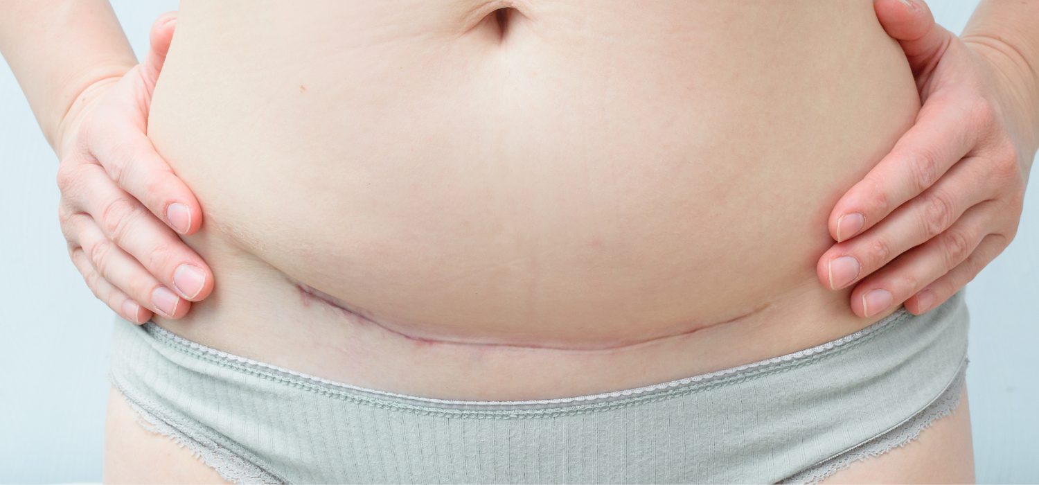 C-section scar endometriosis – yes, it’s a thing