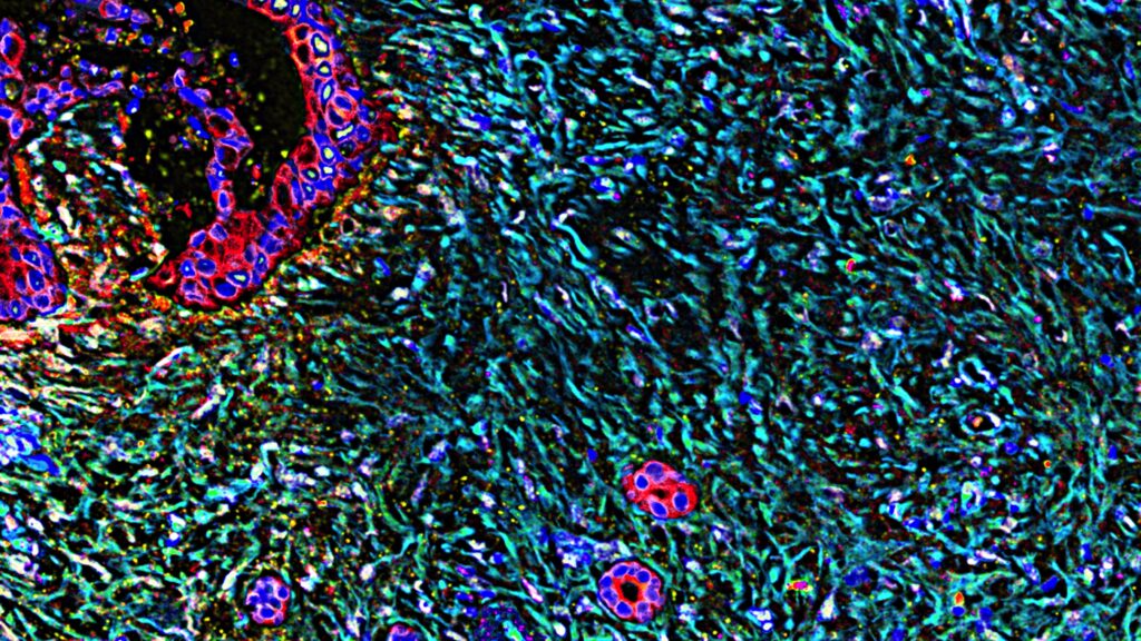 Expert analyzes potential new pancreatic cancer breakthrough